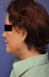 Laser Liposuction Before and After Pictures in Baltimore, MD