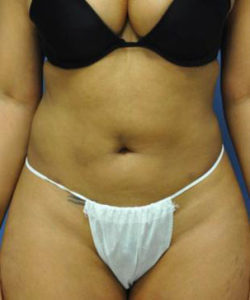 Liposuction Before and After Pictures in Baltimore, MD