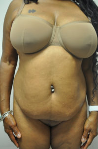 Liposuction Before and After Pictures in Baltimore, MD